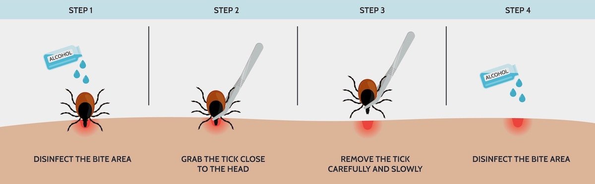 illustration of how to remove a tick, the correct way to remove a tick
